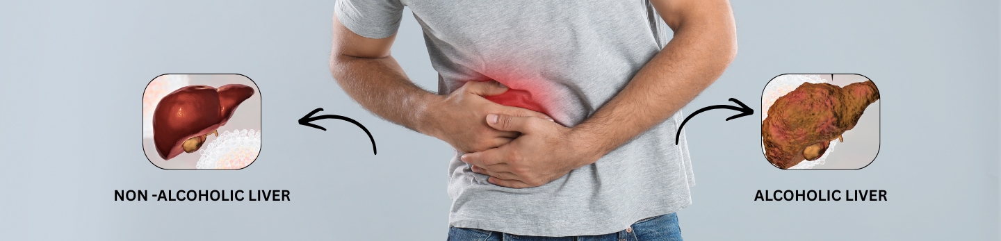 Alcoholic vs Non-Alcoholic Fatty Liver Disease: Causes, Symptoms & Cure