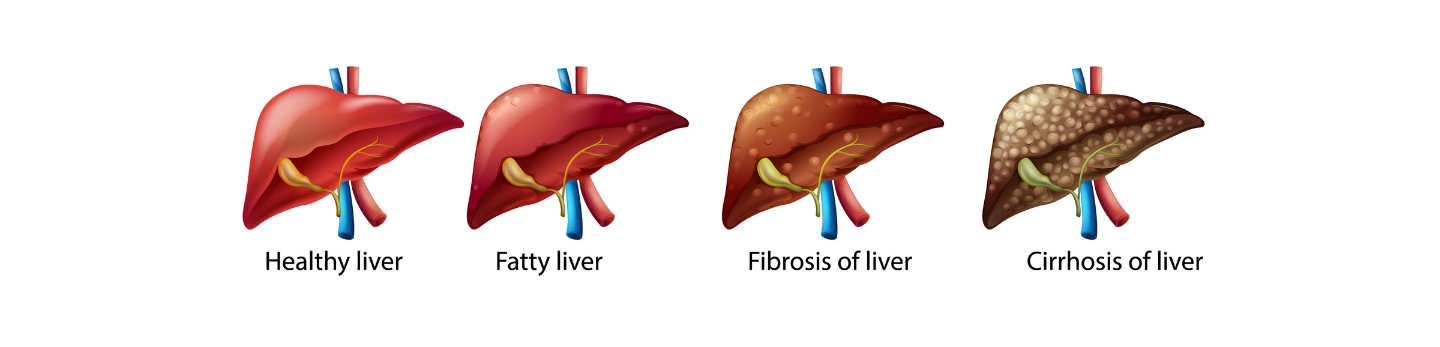 Hepatitis B Treatment Infection: Virus, Symptoms, Causes & Treatment Guide